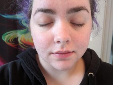 M&M_S13E02_Melanie Franck_Micro Needling_AFTER