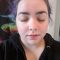 Micro Needling Benefits