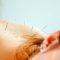 Wellness Fix: Acupuncture & Intramuscular Stimulation